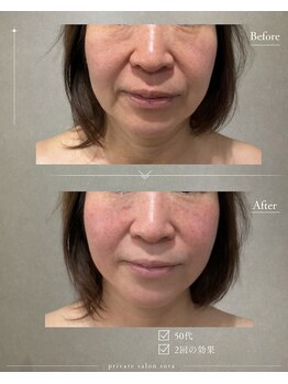 ソラ 天神 大名(SORA)の写真/40代50代のたるみ・ほうれい線に｜切らないリフト「オンリフト」×本格コルギ