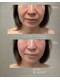 ソラ 天神 大名(SORA)の写真/40代50代のたるみ・ほうれい線に｜切らないリフト「オンリフト」×本格コルギ