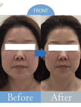 ダイヤモンドビューティー(Diamond Beauty)/最新リフトアップマシーン最強