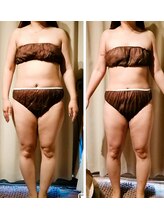 サクラス(SUQRAS)/ビフォーアフター/5回