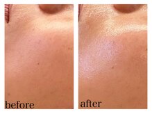 ザ ワン(THE ONE)/ハイドラフェイシャルほうれい線