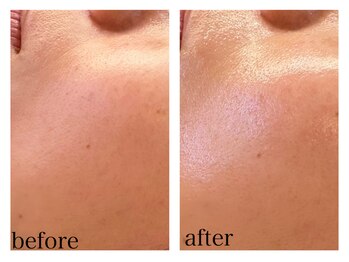 ザ ワン(THE ONE)/ハイドラフェイシャルほうれい線