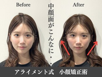 アライメント 自由が丘(Alignment)/中顔面の改善♪
