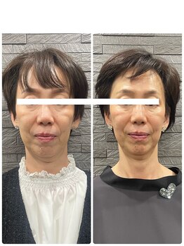 長寿鍼灸院 長寿整骨院/ハリネズミ女優美容鍼効果★