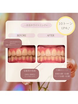 プラスビー 2号店(+b)/ホワイトニングビフォーアフター