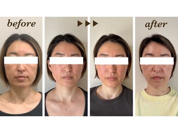 マカオン(machaon)/【小顔リフト】小顔マッサージ