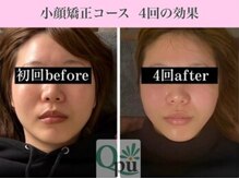 キュープ 下北沢店(Qpu)/小顔矯正4回コースの変化