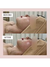 ミーティス/顎下・フェイスラインの術後ケア