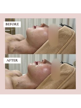 ミーティス/顎下・フェイスラインの術後ケア