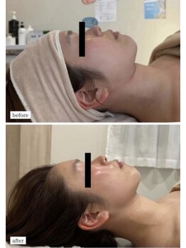 エミット(emit.)/脂肪燃焼剤導入＆小顔矯正