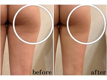 リーインカーナ アーティスト(REINCARNA ARTIST)/【ボディ痩身】ビフォーアフター