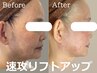小顔No.1★切らない＆ダウンタイムなし小顔＆リフトUP術(サーモシェイプDeep)
