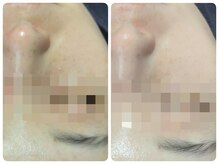 トータルビューティ ノイド(Noid)/毛穴洗浄　お試し全顔