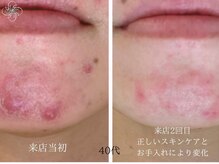 パーム(Palm)/ここまで変わるお手入れ法は