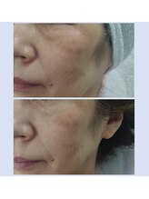 シュシュレ 博多(ShushuLe)/50代１回アイバック・ホウレイ線