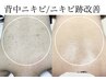 【継続相談向け】背中ニキビ・ニキビ跡・毛公孔苔癬★6施術改善¥22200→6500