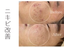 アニール(aniR)/ハーブピーリング/フェイシャル