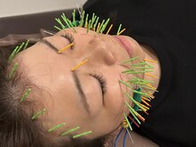 ソラナ(Solana)/美容鍼（百華鍼）