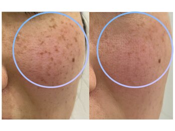 ルナ(Luna)/シミケア効果