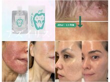 アンド(AND/&)/アズイリス炭酸ガスパック！