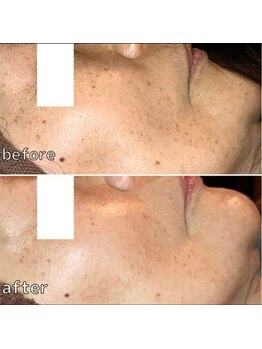 ルアナ 柏店(LUANA)/シミ小ジワ改善例