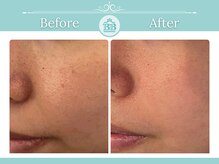 シミケアゼロ美人 表参道店(シミケアZERO美人)/【シミケア/シミゼロ症例】