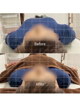 ナオル整体 池袋院(NAORU整体)/猫背矯正の施術前後