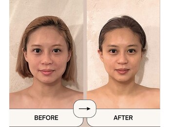 アメアラレ(amearare)/小顔コルギ 90分 5回施術