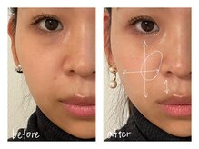 ミースプラス(me,as+)/高周波サーマ 全顔1回 (術後2w)