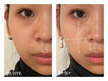 ミースプラス(me,as+)/高周波サーマ 全顔1回 (術後2w)