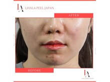 タイムレス バイ サロンリーナ(Timeless by salon Lena)の雰囲気（ララピールは、しみしわニキビなど様々なトラブルに対応。）