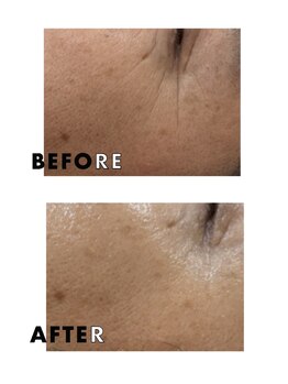 ナルフロウ(nalufurou)/REVIVEハーブピーリング