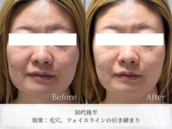 アストリエ グレース 相模大野(Astorie Grace)/1回でもリフトアップ!