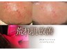 荒れたお肌の肌改善プログラム　　　