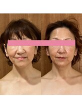 サロンドミジュ(Salon de 美jyu)/最高品質ヒト幹細胞上清液導入