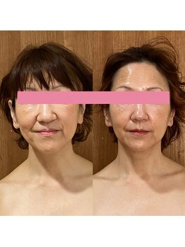 サロンドミジュ(Salon de 美jyu)/最高品質ヒト幹細胞上清液導入