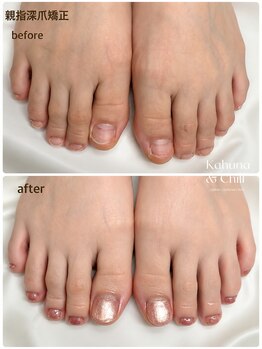 フット深爪矯正×ワンカラー