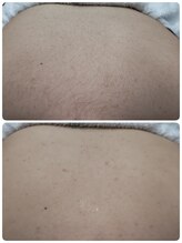 エステシェービングサロン フルール(Fleur)/背中のシェービング