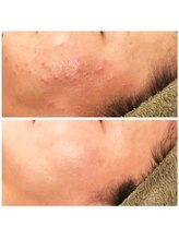 グランデ(Grande)/お肌が変わる陶肌トリートメント