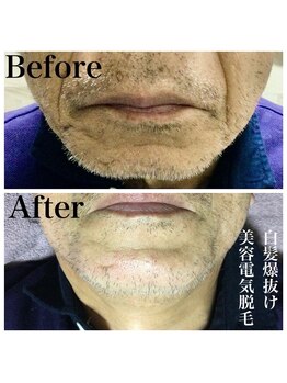 トータルメンズエステ キング(KING)/●白髪も確実に抜ける電気脱毛●