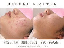 ロエヴェ(ROEWE)/ニキビ改善・毛穴ケア・肌質改善