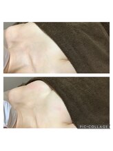 アップオー 小倉店(up・O)/体験者様　施術例