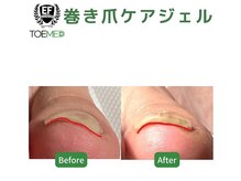 エヌ(N)/巻き爪ケア