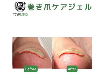 エヌ(N)/巻き爪ケア