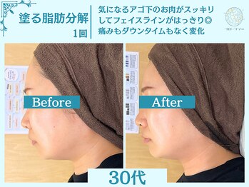 フローフシ∞/【小顔】塗る脂肪分解&燃焼