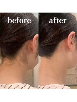 ミノア 大野城店(MINOA)/うなじ脱毛◆ビフォーアフター