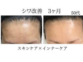 シャルナ(charna)/シワ改善症例 3ヶ月