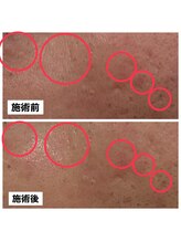 エステティック アントワネット/高濃度水素LEAP+ララピール1回