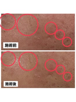 エステティック アントワネット/高濃度水素LEAP+ララピール1回