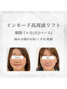 メディカルエステ 東銀座店/業界初インモード高周波リフト 